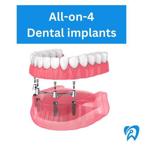 All On 4 Dental Implants Istanbul Teo Dental Clinic