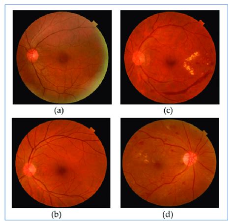 Sample images from both classes: (a,b) Healthy fundus. (c,d) DR fundus ...