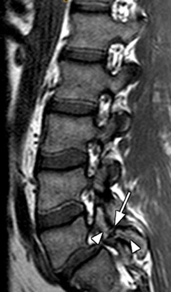 Spondylolysis Mri