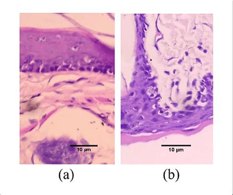 Histopathological Image Of Epithelial Dysplasia In Oscc A Initial