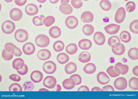 Target Cells With Abnormal Red Blood Cells In Blood Smear Stock Image