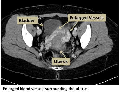 Pelvic Congestion Syndrome Interventional Radiology Ucla Health