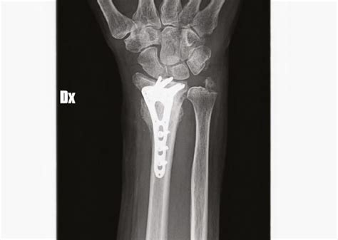 Ulnar Styloid Fracture Splint