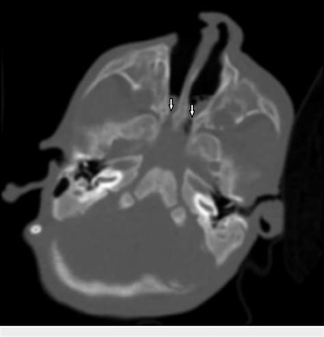 Figure 2 From A Case Report Of Late Diagnosis Of Bilateral Choanal Atresia Semantic Scholar