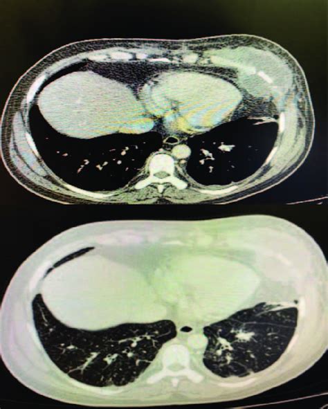 Computed Tomography Imaging Showing Fluid Collection With A Loose