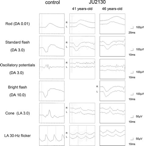 Full Field Electroretinographic Findings The Patient JU2130