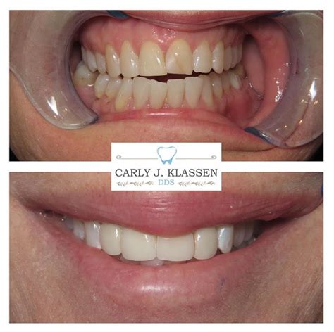 Whitening And Veneers Carly J Klassen DDS