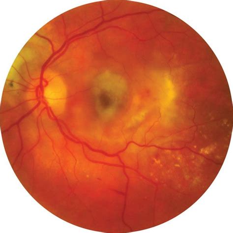 Macular degeneration | Description, Forms, & Symptoms | Britannica