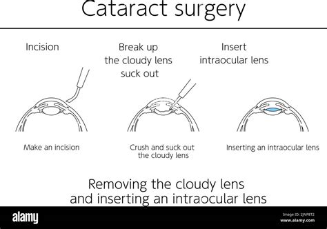 Illustrations Cataract Surgery Medical Illustrations Stock Vector