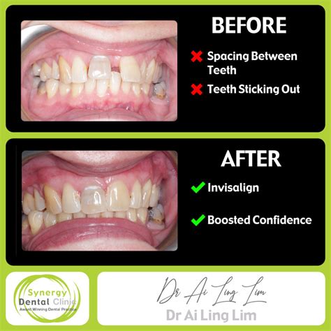 Before and After Teeth Straightening • Synergy Dental Clinics