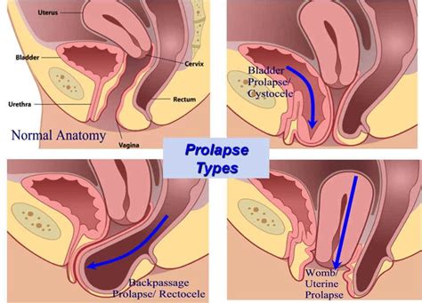 Prolasso Uterino Femminile