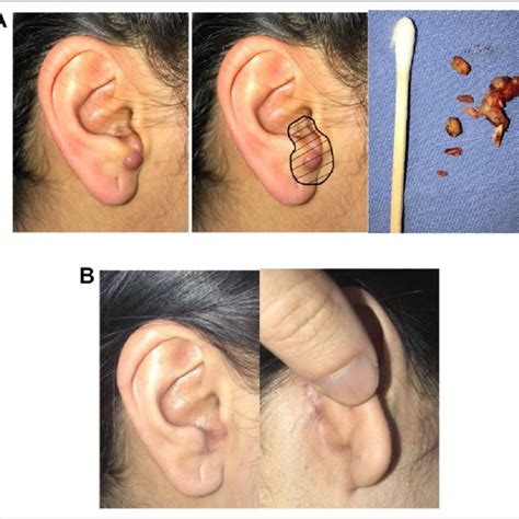 A Reddish Nodules In The External Auditory Canal With Involvement Of