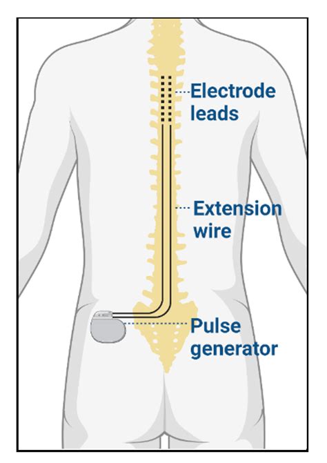 Spinal Cord Stimulation Openanesthesia