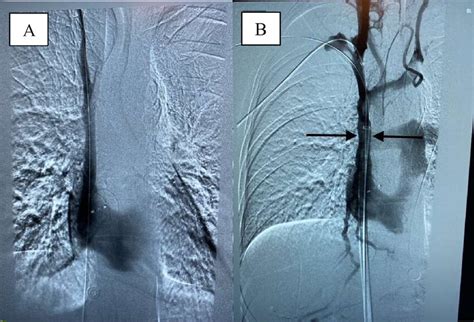 X Ray Venography Showing A Non Obstructed Svc Post Thrombectomy A Download Scientific