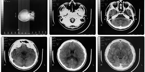 Treating Pituitary Tumors: Symptoms & Surgery | Advanced Neurosurgery