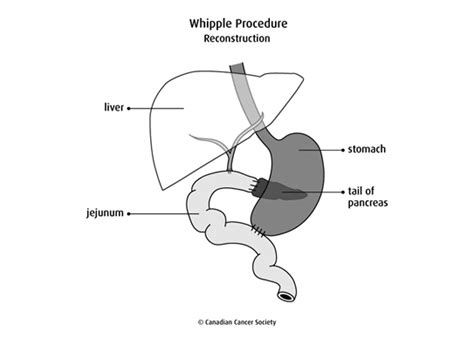 Surgery For Pancreatic Cancer Canadian Cancer Society