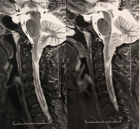 Malformação De Chiari E Siringomielia Neurocirurgião Bh