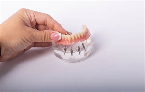 4 Advantages Of All On Four Dental Implants Vs Dentures Mulgrave Dental