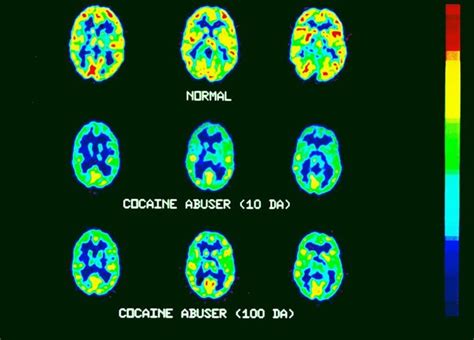 Efectos de la cocaína en tu cerebro