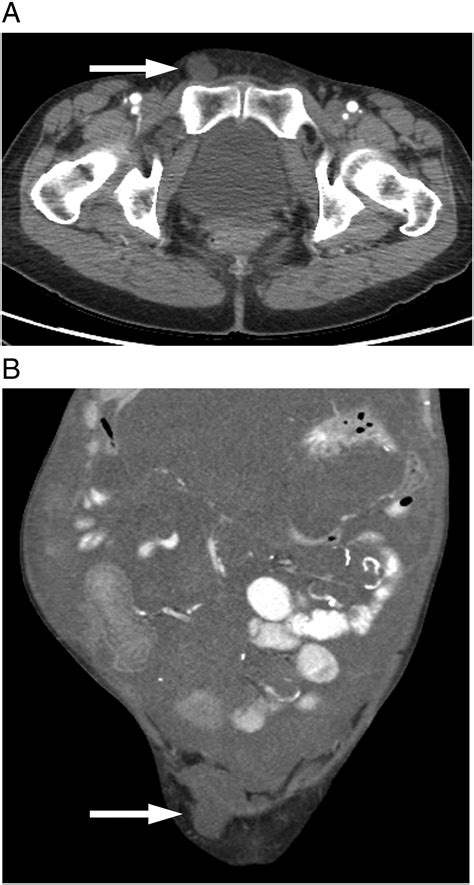 Anatomy And Pathology Of The Canal Of Nuck Clinical Imaging