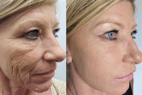 Rejuvenece con PRP Dermapen Rejuvenecer sin Cirugías