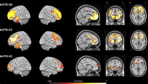 Voxelbased Morphometryderived Gray Matter Atrophy Maps Of Each