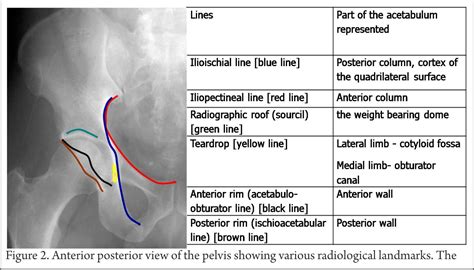 Management Of Acetabulum Fractures Basic Principles And Tips And