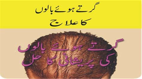 Hair Fall Girte Balon Ka Ilaj In Urdu Girte Hue Balon Ko Rokne Ka