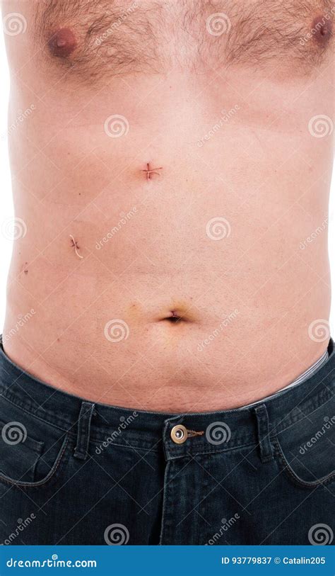 Male Abdomen With Fresh Stitches After Gallbladder Removal Royalty Free Stock Image