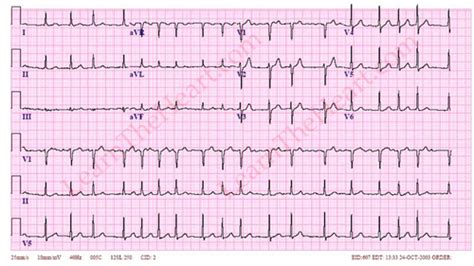 Ekg Practice Flashcards Quizlet