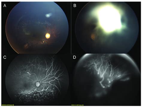 Color Fundus Cf And Fluorescein Angiography Fa Photographs Of Download Scientific Diagram