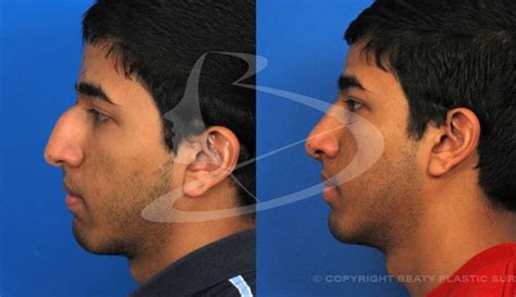 Deviated Septum Nose Job Before And After Angelena Silver