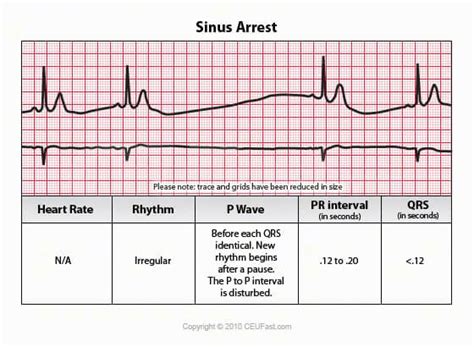 EKG ECG Interpretation Course CEUfast Nursing Continuing Education