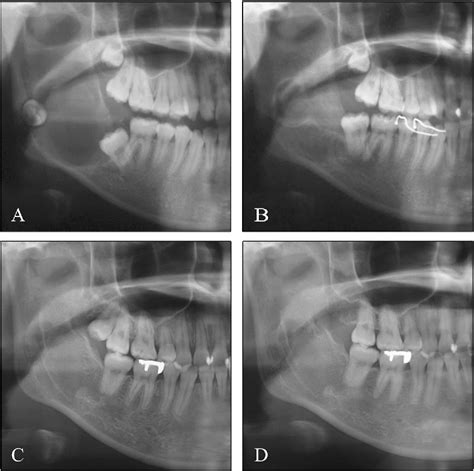 Figure From Orthodontic Occlusal Reconstruction After Conservative