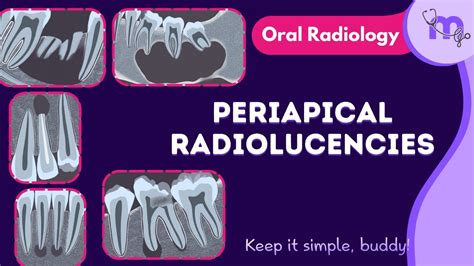 Periapical radiolucencies - Differential diagnosis , Radiographic ...