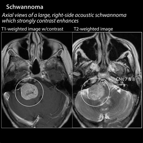 Pathology Glossary: Schwannoma | Draw It to Know It