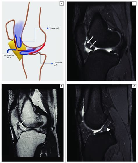 Magnetic Resonance Imaging Of Normal Synovial Clefts In Hoffas Fat