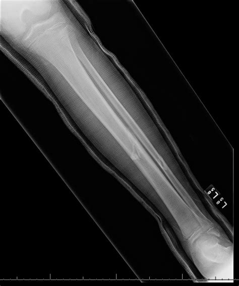 Pediatric Tibial Fracture