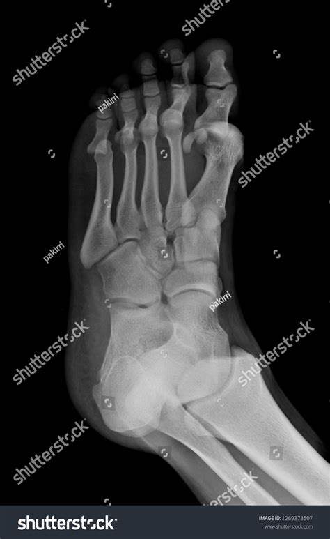 Fracture Bones Foot Stock Photo 1269373507 | Shutterstock