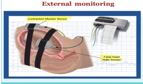 Fetal Surveillance Flashcards Quizlet