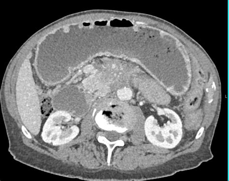 Adenocarcinoma Body Of Pancreas With Vascular Invasion Pancreas Case