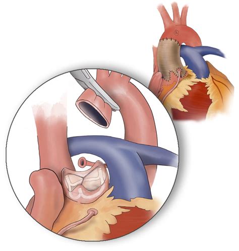 Aortic Root Restoration – BioStable Science & Engineering