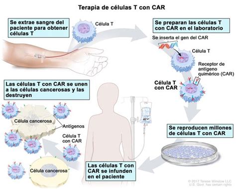 Definición de terapia de células T con CAR Diccionario de cáncer del