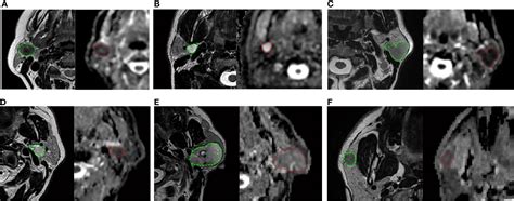 Frontiers Mri Based Radiomics To Differentiate Between Benign And