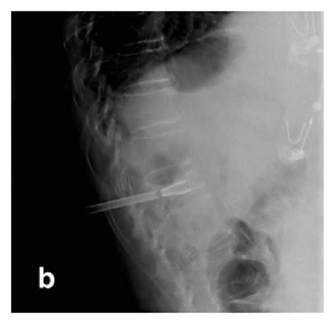 Lateral Fluoroscopic Projections Showed Progressive Deployment Of