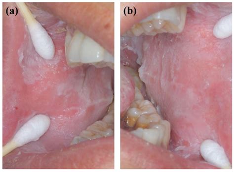 White Sponge Nevus Gingiva