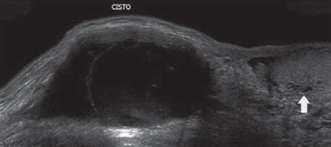 B Mode Us With Extended Field Of View Spermatic Cord Cyst In