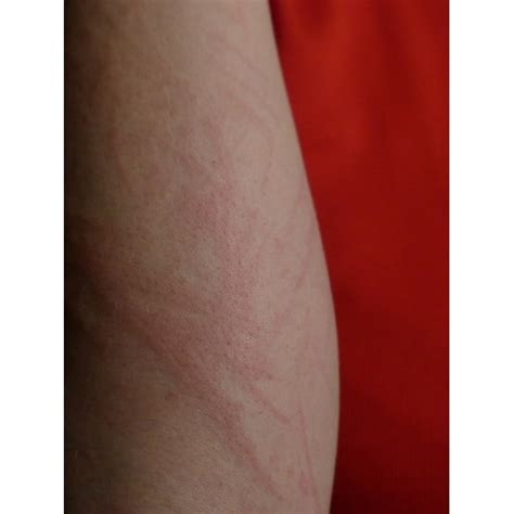 Redness Upper Arm Reddening Of The Skin Rash Arm 12 Inch By 18 Inch