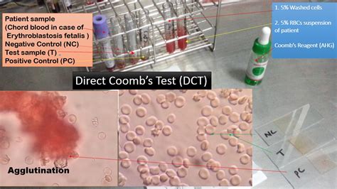 Direct Coomb Test DCT Introduction Principle Procedure Result Interp