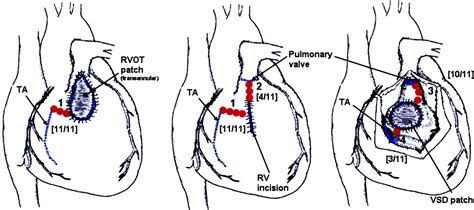 Catheter Ablation Of Ventricular Tachycardia After Repair Of Congenital